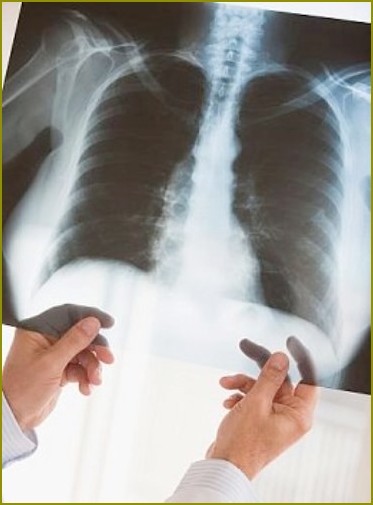 Jak odróżnić zapalenie oskrzeli od zapalenia płuc