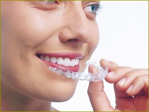 Jak wyprostować zęby przednie